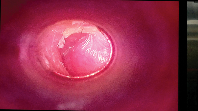 IAORL_Journal's tweet photo. Original Research Article: "A Clinicopathological Study of Aural Polyps: A Retrospective Analysis in a Tertiary Care Hospital"

🔗https://t.co/O6x9SbTESd

#medresearch #auralpolyps #otorhinolaryngology #MedTwitter #clinicopathological https://t.co/5unheYEMya