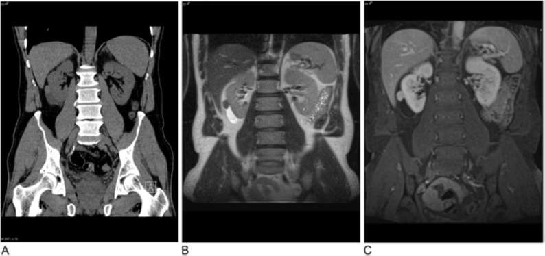 Urology Gold Journal (@urogoldjournal) on Twitter photo Malignant Mixed Epithelial and Stromal Tumor of the Kidney in an Adult Male Patient: A Case Report
goldjournal.net/article/S0090-…
What Would You Do Next?
A) Observation
B) Renal mass biopsy
C) Partial nephrectomy
D) Radical nephrectomy
E) Imaging to determine staging
<a href="/eiftu/">Eiftu #BlackLivesMatter</a> Malignant Mixed Epithelial and Stromal Tumor of the Kidney in an Adult Male Patient: A Case Report
goldjournal.net/article/S0090-…
What Would You Do Next?
A) Observation
B) Renal mass biopsy
C) Partial nephrectomy
D) Radical nephrectomy
E) Imaging to determine staging
<a href="/eiftu/">Eiftu #BlackLivesMatter</a>
