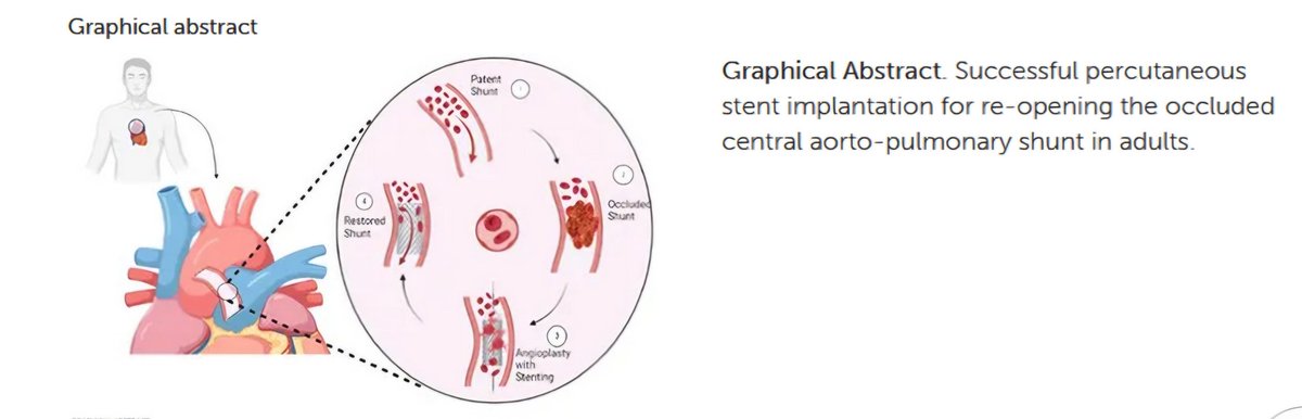 Percutaneous stent implantation is effective for occluded systemic-to-pulmonary shunts in adults with complex congenital heart defects. Our review of 31 studies shows a 97.5% success rate, a less invasive alternative to surgery. #Cardiology #CHD #Stent
# frontiersin.org/journals/cardi…