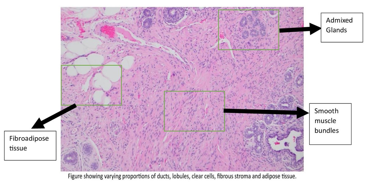 Mammary hamartomas are benign breast lesions made of an unusual mix of glandular, adipose, and fibrous tissues. Rare, but important to distinguish from other breast tumors. 🩺🔬#PathTwitter #EmoryHealthcare #BreastPathology #Histopathology #BreastHealth