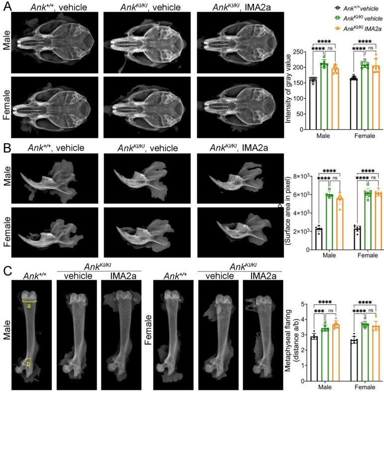 JBMRPlus's tweet photo. A new study in #JBMRPlus examines IMA2a treatment for craniometaphyseal dysplasia, a rare genetic bone disorder characterized by progressive thickening of craniofacial bones and flared metaphyses of long bones @ASBMR @OUPMedicine #rarebone

Read more here: https://t.co/i10fwtyGil https://t.co/8UqUi8DaUW
