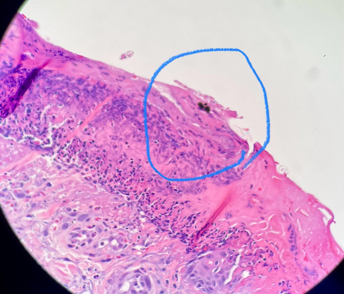 Sometimes this is the only clue for the diagnosis for a biopsy from someone itching and scratching like crazy for weeks 😒 #dermpath #dermatology #scabies