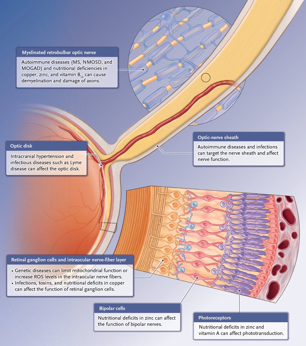 NEJM's tweet photo. Causes of Optic Neuropathy According to Site of Injury https://t.co/4l3UQ5KGCz

#Ophthalmology https://t.co/RyqTsZbYih