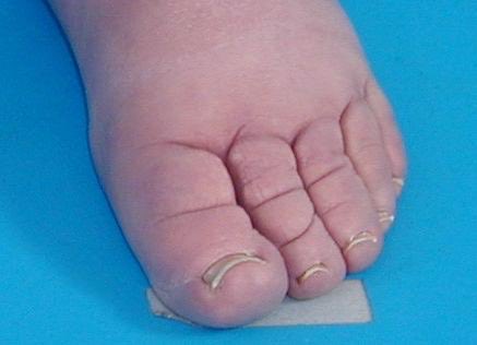 cuttingedgempl's tweet photo. Stemmer’s sign is due to?

A. Lipodystrophy
B. Retroperitoneal fibrosis
C. Subcutaneous fibrosis
D. Deep vein thrombosis https://t.co/kSFdiUOSLW