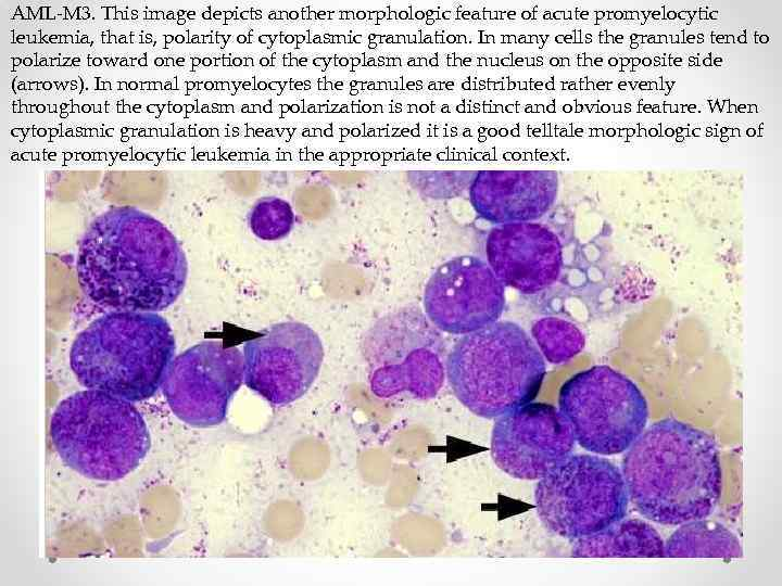 martahusto43409's tweet photo. @PeterPeterV20 Most of the six billion people that will be killed by the #COVID19 ๐will be killed by #TurboCancer. Nothing kills a person as bad as #AML. People are facing the worst death imaginable. --#MartaPath https://t.co/vvg1Ybtzu4