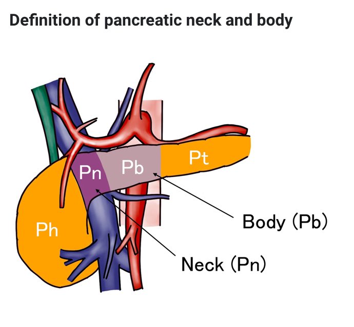 Thomas Stoop (@tfstoop) on Twitter photo Dear pancreas surgeons, please fill in this 🌏international survey✏️ on #pancreatic neck/body #cancer with portal vein involvement on behalf of <a href="/JSHBPS/">Japanese Society of HBP Surgery</a> <a href="/EAHPBA/">E-AHPBA</a> <a href="/EurPancClub/">EPC-Europ Pancr Club</a> <a href="/IHPBA/">IHPBA</a> <a href="/AHPBA/">AHPBA</a> <a href="/PancreasClub/">The Pancreas Club</a> <a href="/AHPBA/">AHPBA</a>
docs.google.com/forms/u/0/d/e/…
<a href="/hpb_so/">SoMe4HPB</a> <a href="/Gio_Marchegiani/">Giovanni Marchegiani</a> <a href="/BasGrootKoerkam/">Bas Groot Koerkamp</a> Dear pancreas surgeons, please fill in this 🌏international survey✏️ on #pancreatic neck/body #cancer with portal vein involvement on behalf of <a href="/JSHBPS/">Japanese Society of HBP Surgery</a> <a href="/EAHPBA/">E-AHPBA</a> <a href="/EurPancClub/">EPC-Europ Pancr Club</a> <a href="/IHPBA/">IHPBA</a> <a href="/AHPBA/">AHPBA</a> <a href="/PancreasClub/">The Pancreas Club</a> <a href="/AHPBA/">AHPBA</a>
docs.google.com/forms/u/0/d/e/…
<a href="/hpb_so/">SoMe4HPB</a> <a href="/Gio_Marchegiani/">Giovanni Marchegiani</a> <a href="/BasGrootKoerkam/">Bas Groot Koerkamp</a>
