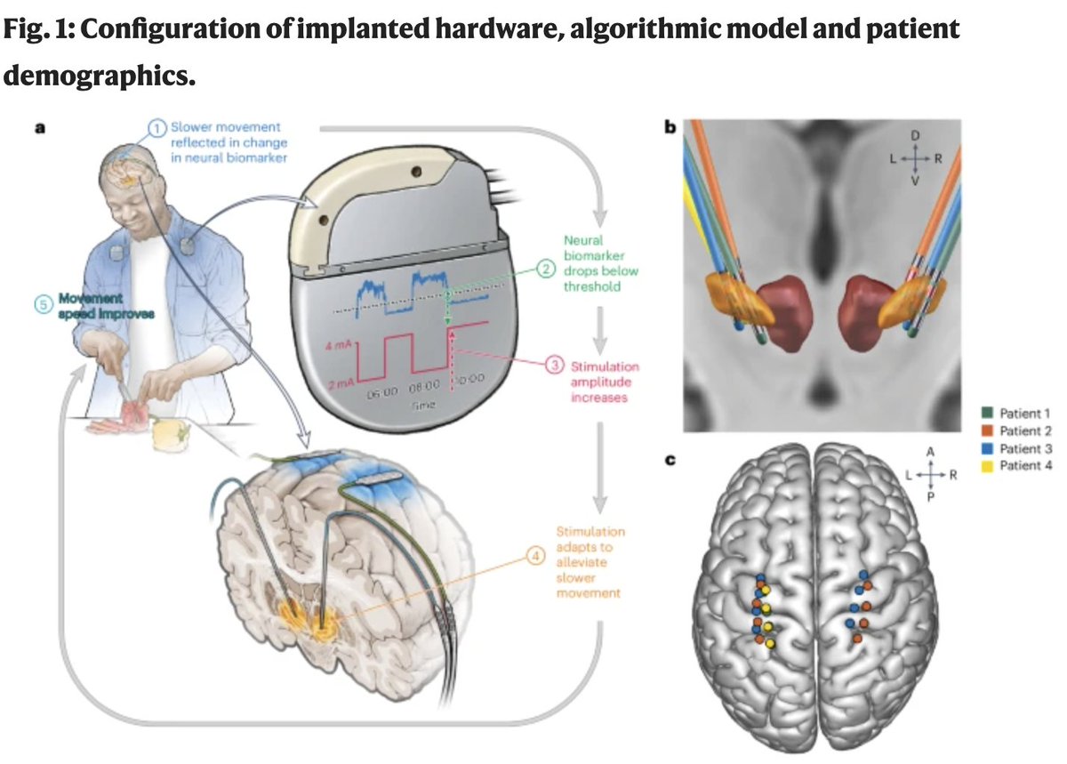 Michael Okun (@michaelokun) on Twitter photo Check out this new paper <a href="/NatureMedicine/">Nature Medicine</a> on chronic adaptive deep brain stimulation versus conventional DBS in Parkinson’s disease: a blinded randomized feasibility trial where they 'flipped the script and used gamma oscillations,' by Carina R. Oehrn, @scernera1, <a href="/littleneuro/">Simon Little</a> and Check out this new paper <a href="/NatureMedicine/">Nature Medicine</a> on chronic adaptive deep brain stimulation versus conventional DBS in Parkinson’s disease: a blinded randomized feasibility trial where they 'flipped the script and used gamma oscillations,' by Carina R. Oehrn, @scernera1, <a href="/littleneuro/">Simon Little</a> and