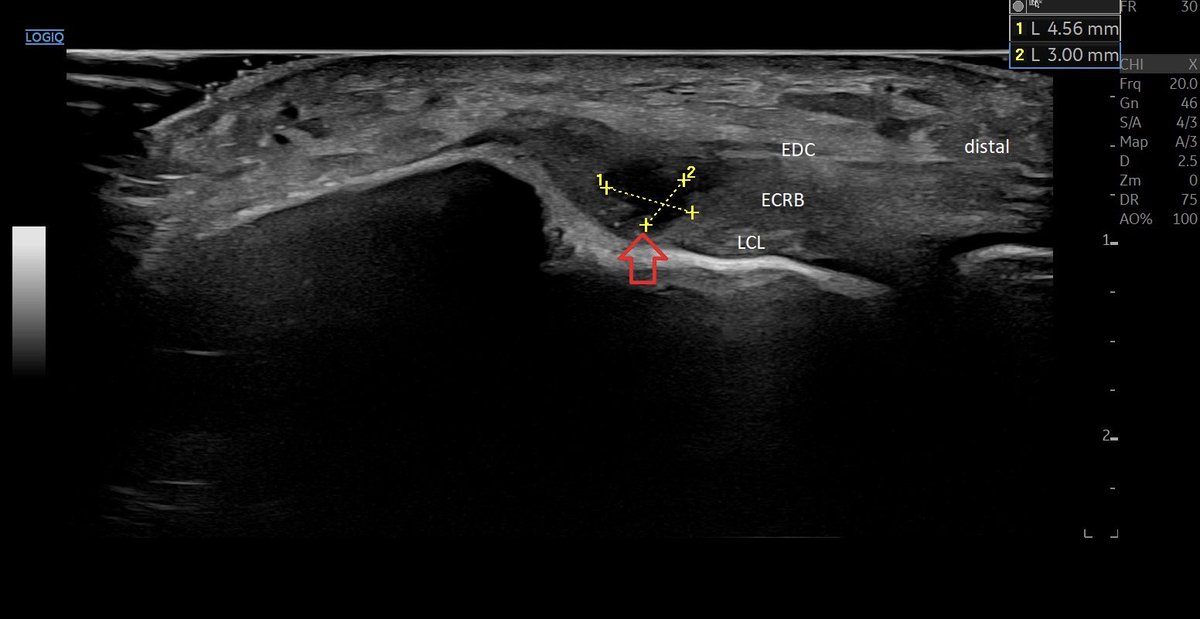 SportklinikBern's tweet photo. #tennisellbow with partial tear and #neovascularization —> #ultrasoundguidedinjection with #arthrexprp and #osteniltendon - #mskus #pocus #pocushub #GElogiqE10r3 https://t.co/SDNABAQYOF