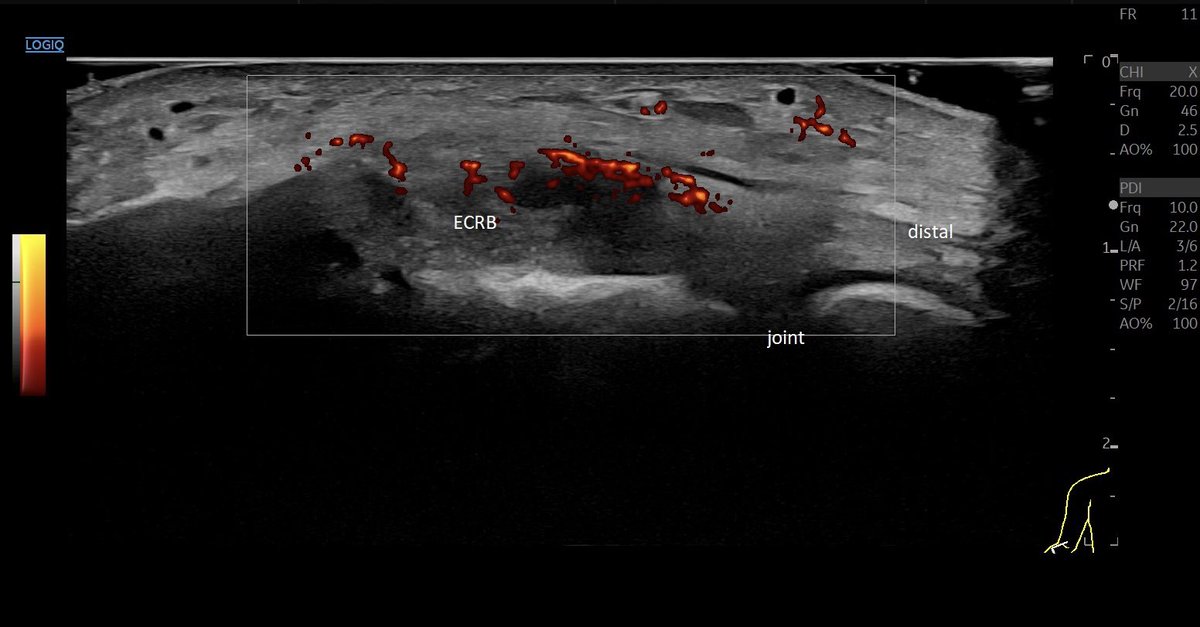 SportklinikBern's tweet photo. #tennisellbow with partial tear and #neovascularization —> #ultrasoundguidedinjection with #arthrexprp and #osteniltendon - #mskus #pocus #pocushub #GElogiqE10r3 https://t.co/SDNABAQYOF