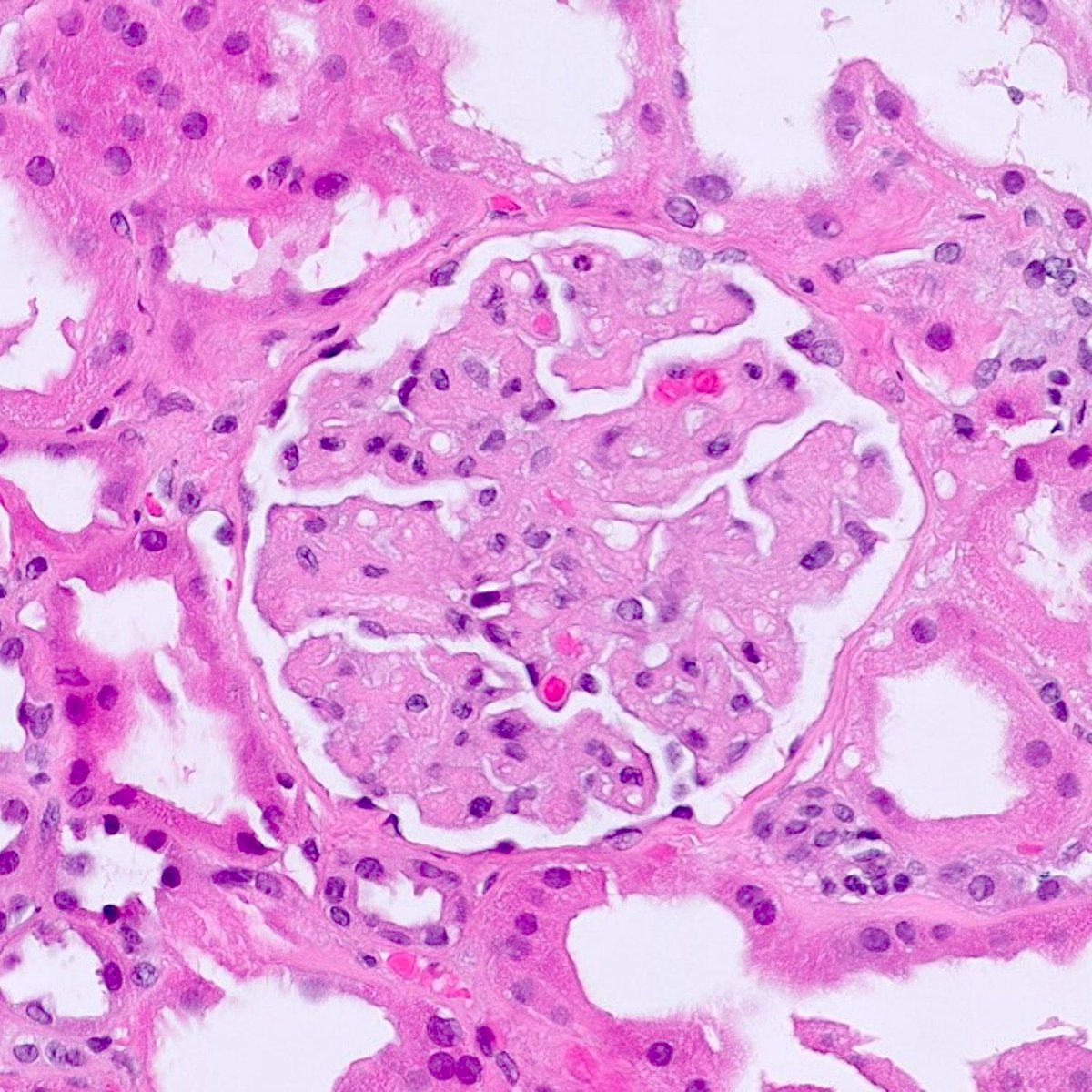 Pathoutlines's tweet photo. Image Quiz!
A 65 year old woman with a history of hematopoietic stem cell transplant presented with acute renal failure and underwent a percutaneous renal biopsy. The H&E of the biopsy is shown in the image. Immunofluorescence was negative.
(Continued)
#PathX #ImageQuiz https://t.co/9s6KGjPj9g