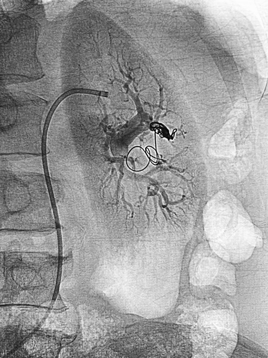 Embolize a renal AVF by coiling (using double catheters) and glue.