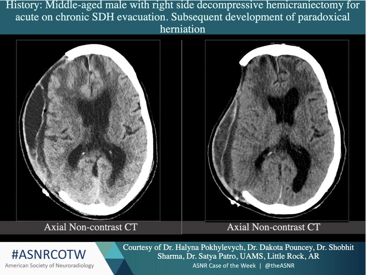 TheASNR's tweet photo. ASNR COTW #209

Hx: Right side decompressive hemi . Subsequent dev of paradoxical herniation.
NO SPOILERS! Give hints in the form of GIFs or answer  poll.                   Answer in 24 hours.                  
#neuro #neurorad #radres #FOAMed #FOAMrad #medtwitter #ASNRCOTW https://t.co/o6xVs8qkAS