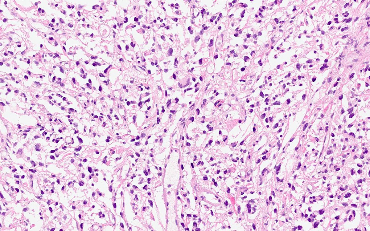 CuringN's tweet photo. CNS & pituitary tumors - What's your diagnosis?
Topic link: https://t.co/PKXkrJcpGa
Images contributed by Antonio d'Amati, M.D. and Francesca Gianno, M.D., Ph.D.
#Cancer #CancerResearch #CuringCancerNetwork #Pathology https://t.co/DoFCJCpO6V