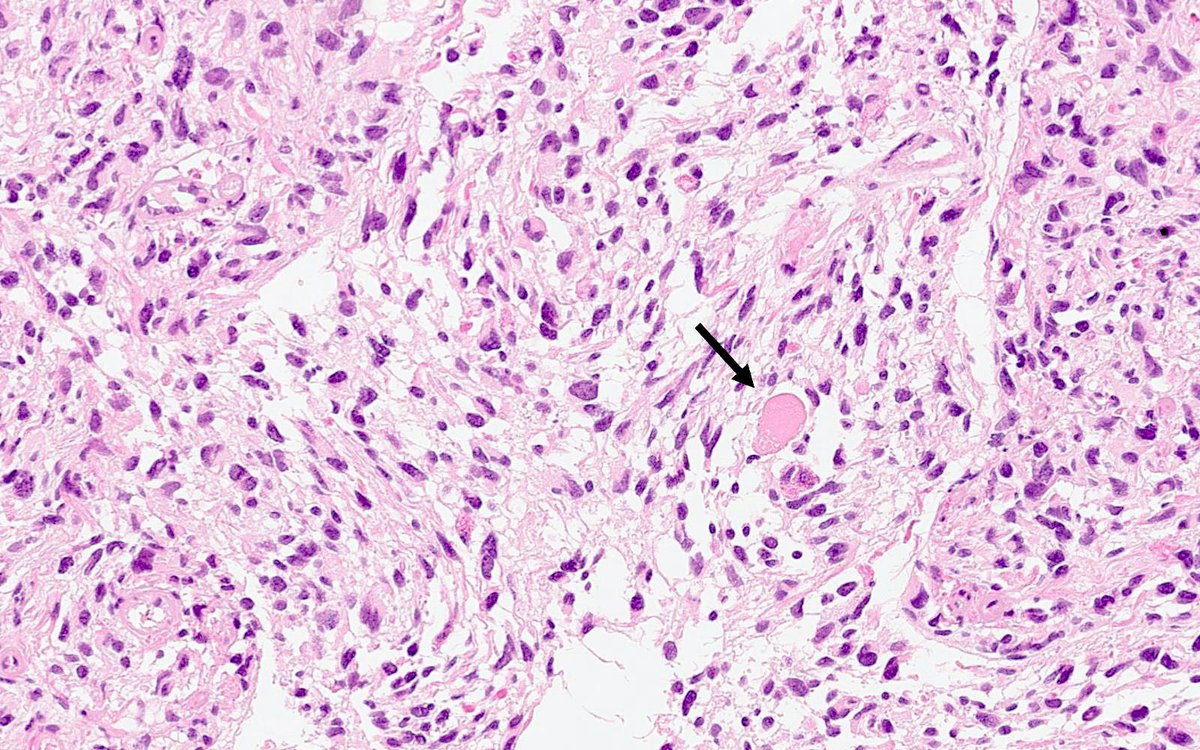 CuringN's tweet photo. CNS & pituitary tumors - What's your diagnosis?
Topic link: https://t.co/PKXkrJcpGa
Images contributed by Antonio d'Amati, M.D. and Francesca Gianno, M.D., Ph.D.
#Cancer #CancerResearch #CuringCancerNetwork #Pathology https://t.co/DoFCJCpO6V