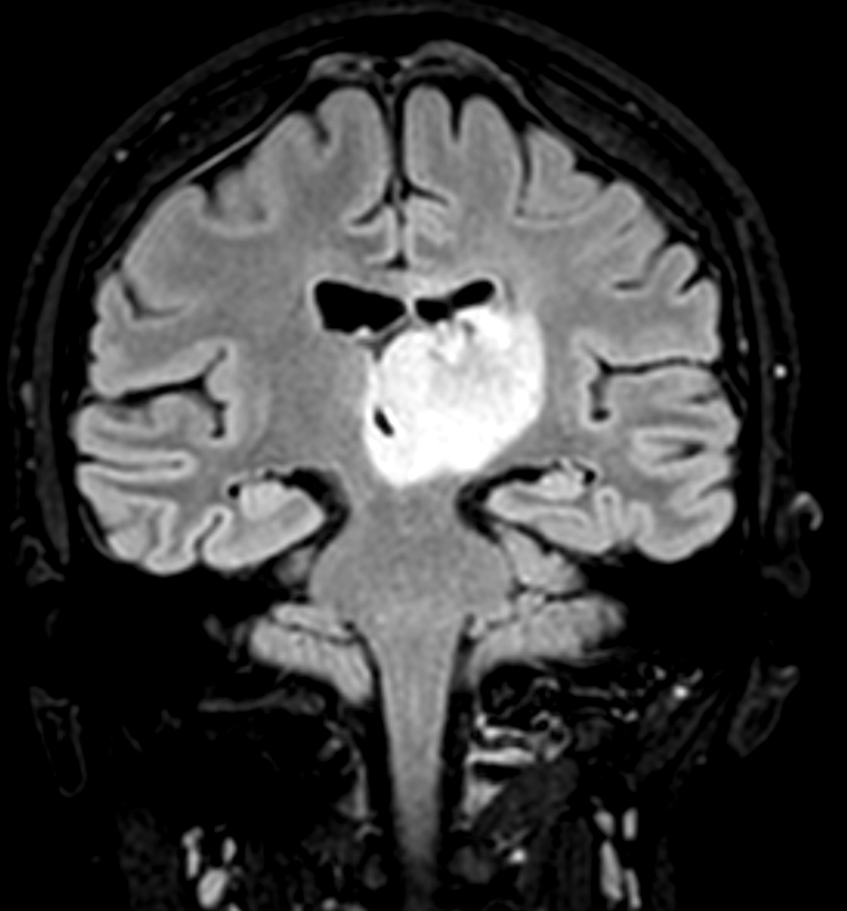 CuringN's tweet photo. CNS & pituitary tumors - What's your diagnosis?
Topic link: https://t.co/PKXkrJcpGa
Images contributed by Antonio d'Amati, M.D. and Francesca Gianno, M.D., Ph.D.
#Cancer #CancerResearch #CuringCancerNetwork #Pathology https://t.co/DoFCJCpO6V