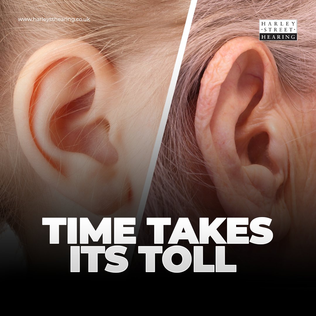 Age-related hearing loss is a gradual decline in hearing that comes with time. It happens due to changes in the inner ear, auditory nerve, and other parts of the hearing system. While genetics play a role, factors like noise exposure and overall health also contribute.