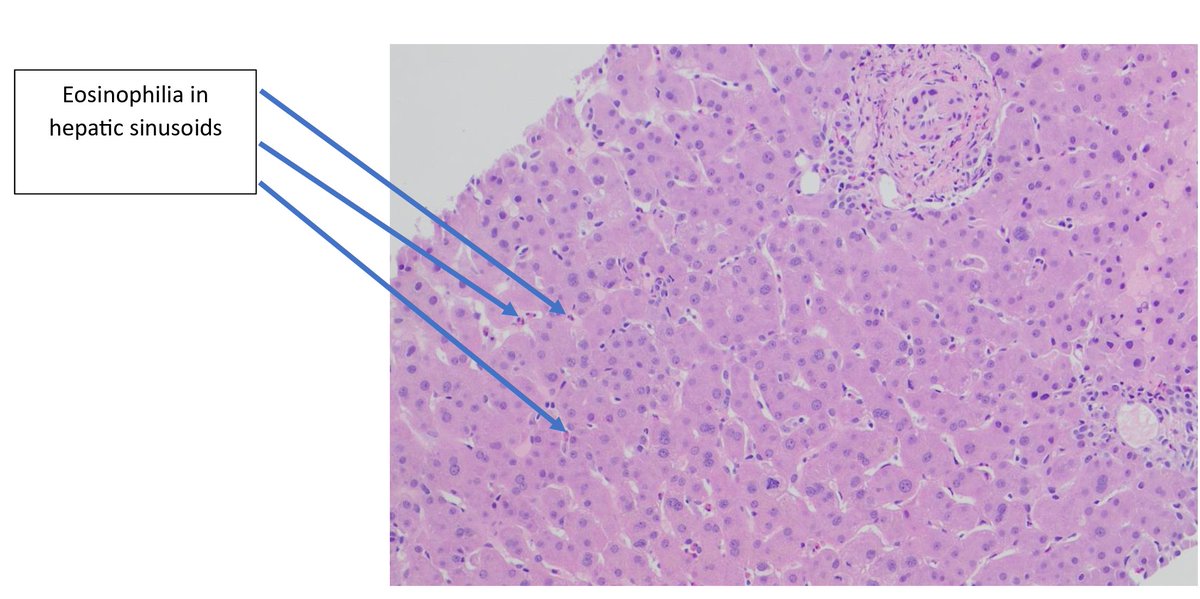 A 45-year-old male with EGPA history and positive p-ANCA showing rare liver involvement. Liver biopsy reveals eosinophilic infiltration. This case highlights how systemic vasculitis can impact any organ. #PathTwitter #Histopathology #EGPA #Vasculitis #EmoryHealthcare