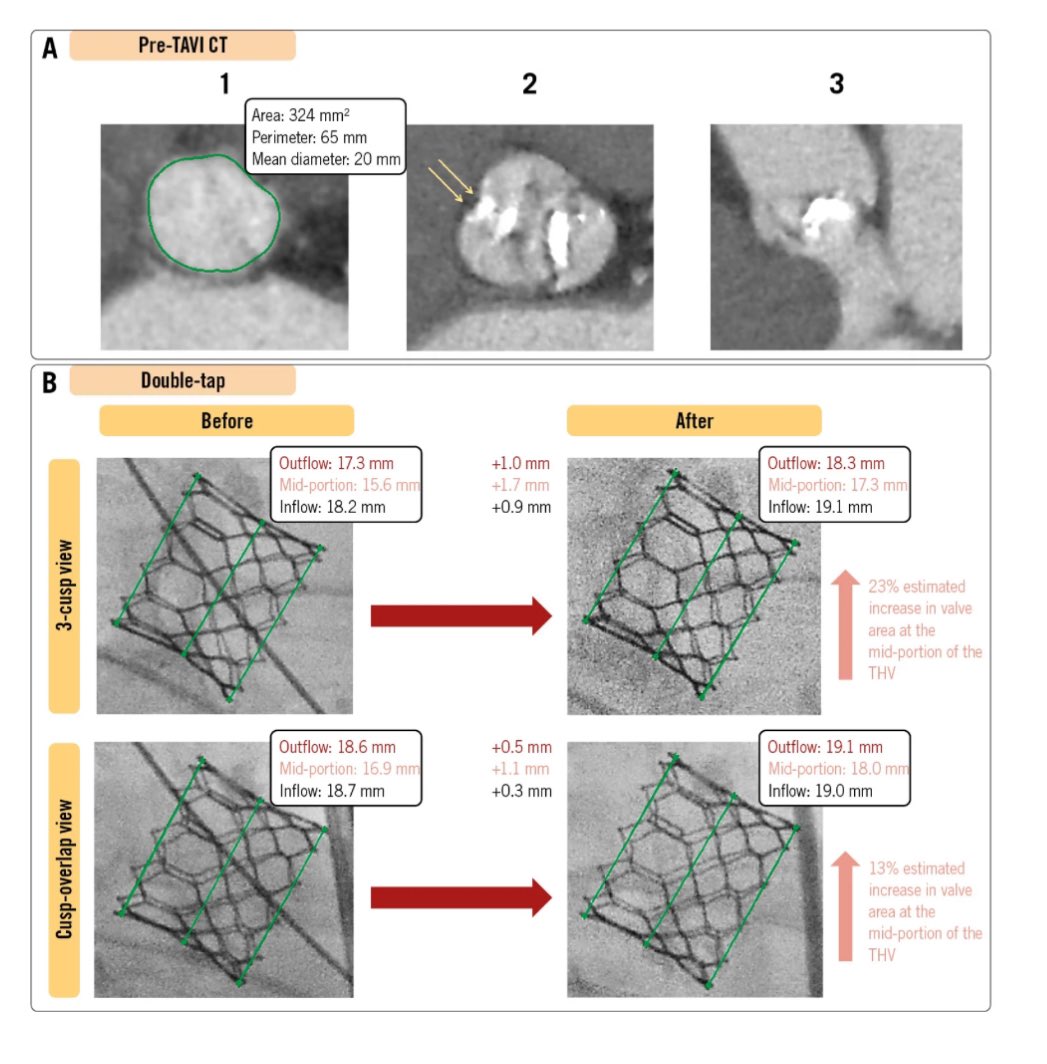 AliSahebHusain's tweet photo. Postdilatation using the same THV system balloon at the same volume (double tap) does work. Here, we highlight the potential benefit of the double tap technique to treat PVL and improve THV expansion in high-risk annuli. @EuroInterventio @escardio 
https://t.co/kjxHshfxfN https://t.co/3scc3ZgUZN