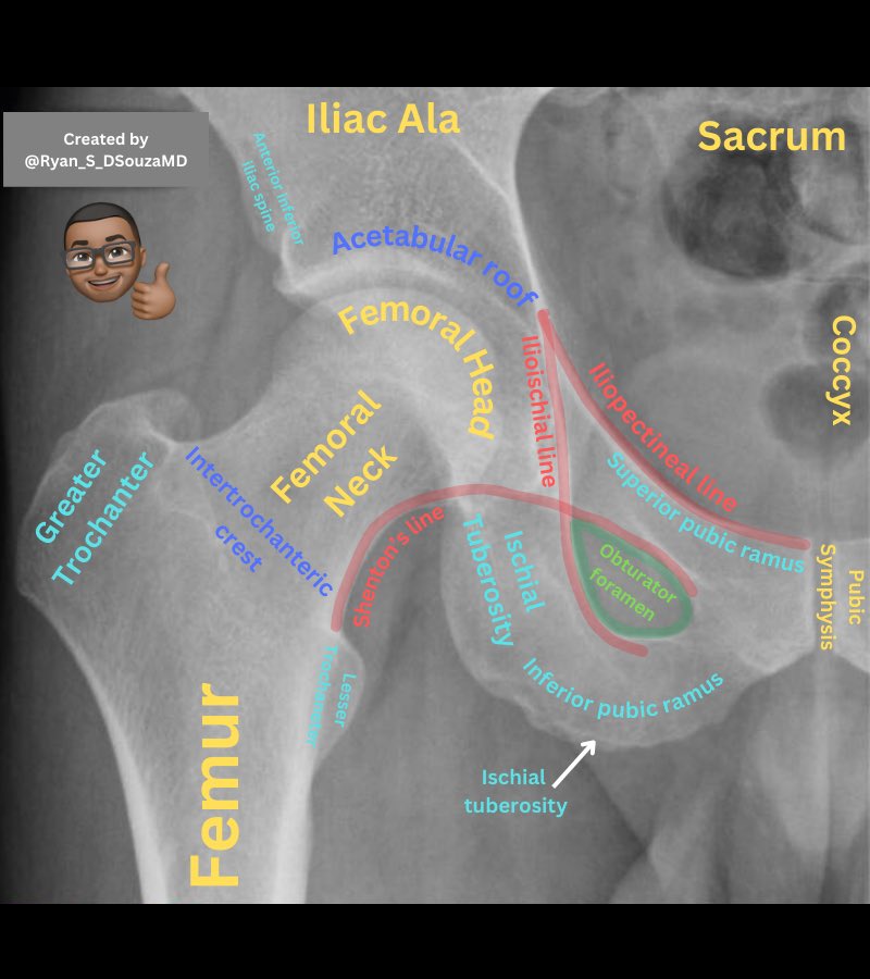 Check out the latest graphic! Learn important anatomical landmarks on hip x-ray📌