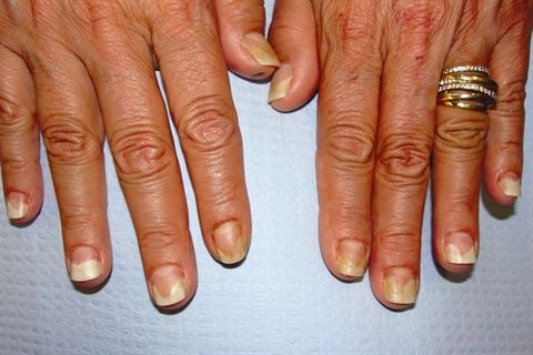The Nail Doctor: Onycholysis, or Nail Separation, Has Different Varieties: One of the most common conditions that affects the nail is onycholysis, which is the separation of the nail plate from the nail bed. Onycholysis occurs as a... nailsmag.com/391824/the-nai…