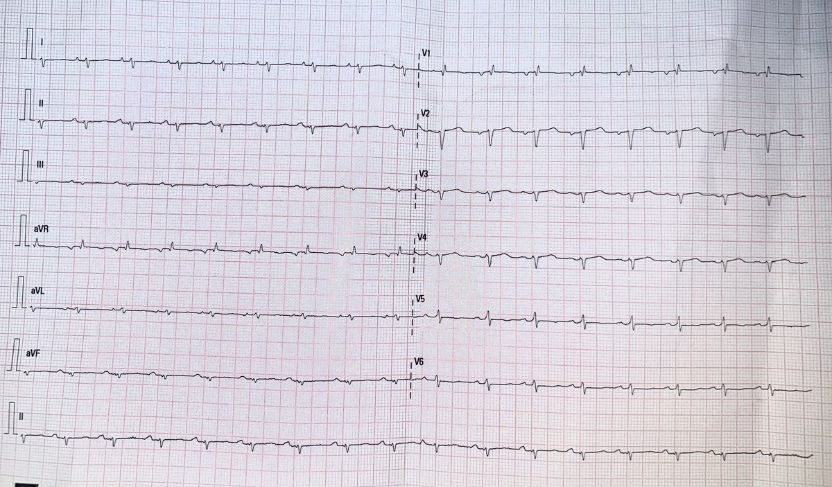 gonzaeperez's tweet image. 53a. 👩🏾 disnea en CFIV 
Diagnóstico probable ? 
#ECGFirst