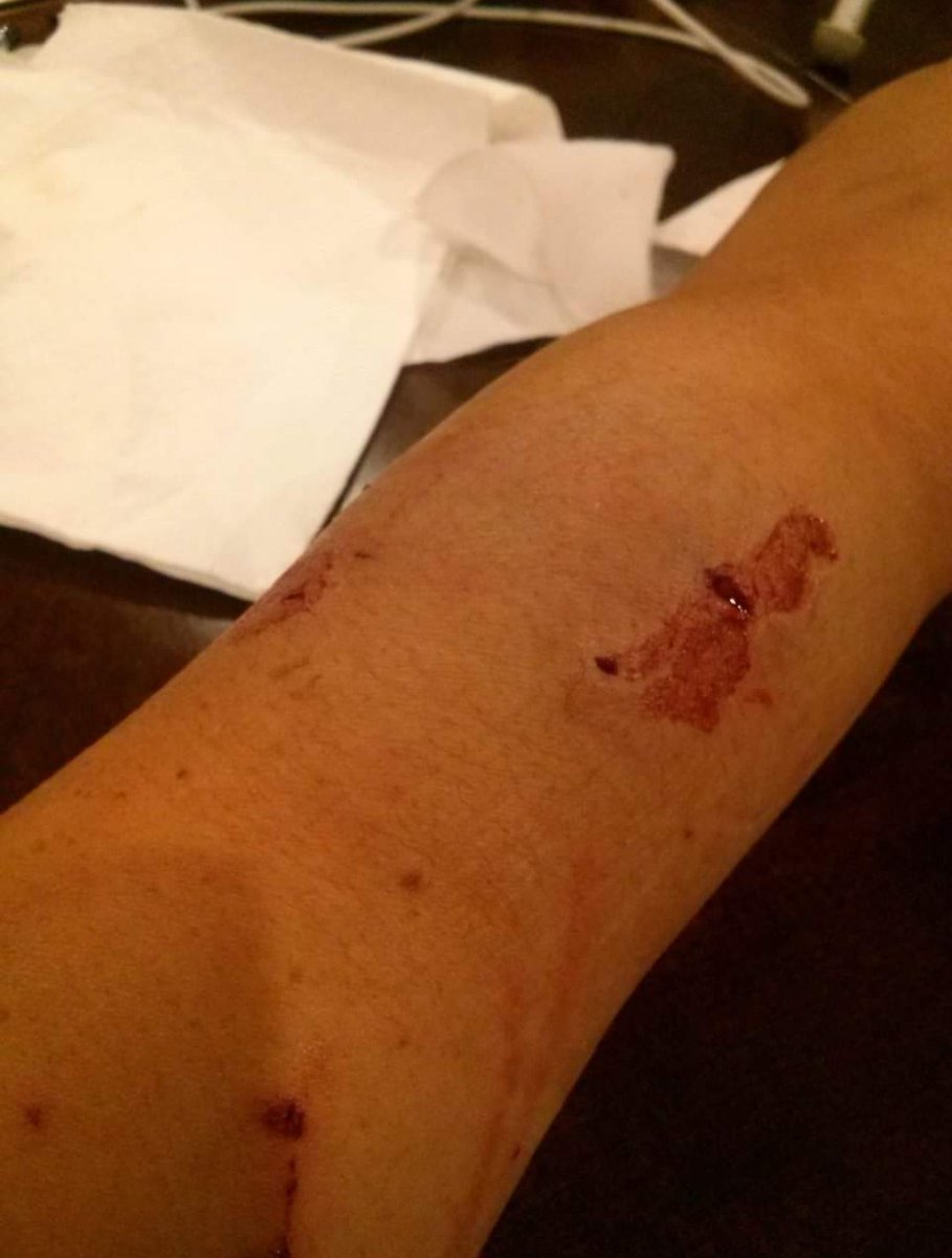 di_winston's tweet photo. @TyOlsson for whatever reason #cameo didn't allow me to send the pics you asked for so sending em to you here (first Pic when I got bit by that dam cat) till now...no more staples please #ughhhhhh #catbite #surgery #dogsrule #catsdrool https://t.co/r0lZtFxz7C