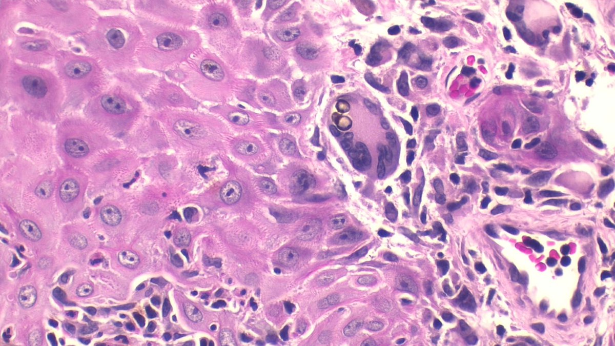 Int Soc Dermpath (@intsocdermpath) on Twitter photo #ISDP #Olympics
Spot diagnosis
Case 20 - <a href="/JCandidoXavier/">Jose Candido</a>
CHROMOBLASTOMYCOSIS
•Pigmented (dematiaceous) fungi
•Prominent pseudoepitheliomatous hyperplasia
•Granulomatous infiltrates with round brownish Medlar bodies resembling copper pennies or coffee beans
#path #derm #ISDP #Olympics
Spot diagnosis
Case 20 - <a href="/JCandidoXavier/">Jose Candido</a>
CHROMOBLASTOMYCOSIS
•Pigmented (dematiaceous) fungi
•Prominent pseudoepitheliomatous hyperplasia
•Granulomatous infiltrates with round brownish Medlar bodies resembling copper pennies or coffee beans
#path #derm