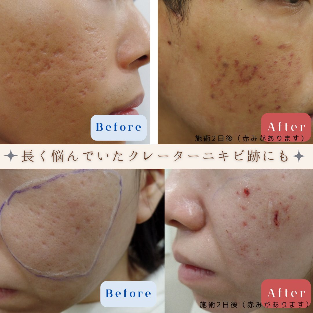 様々な治療を受けても改善が難しい ＃クレーターにきび跡 🥲🥲🥲 当院