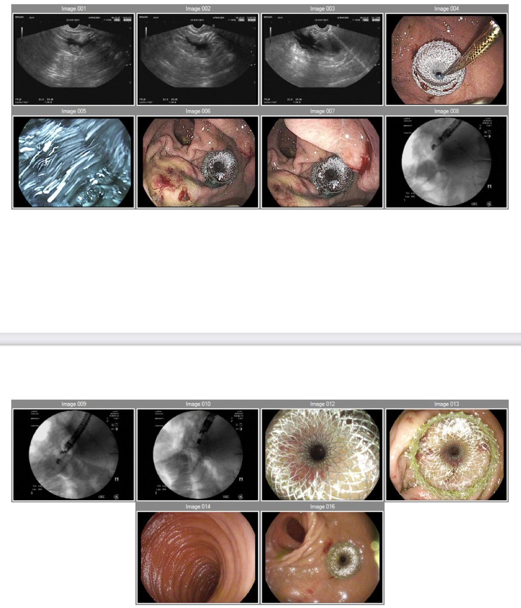 Sanmeet Singh MD (@sanmeetsingh07) on Twitter photo Session I of EDGE -> Endoscopic Ultrasound Directed Trans gastric ERCP.
Given no evidence of cholangitis two staged ERCP was elected.
Stay tuned for session II โญ๏ธ
#GITwitter #asge <a href="/bostonsci/">Boston Scientific</a> Session I of EDGE -> Endoscopic Ultrasound Directed Trans gastric ERCP.
Given no evidence of cholangitis two staged ERCP was elected.
Stay tuned for session II โญ๏ธ
#GITwitter #asge <a href="/bostonsci/">Boston Scientific</a>