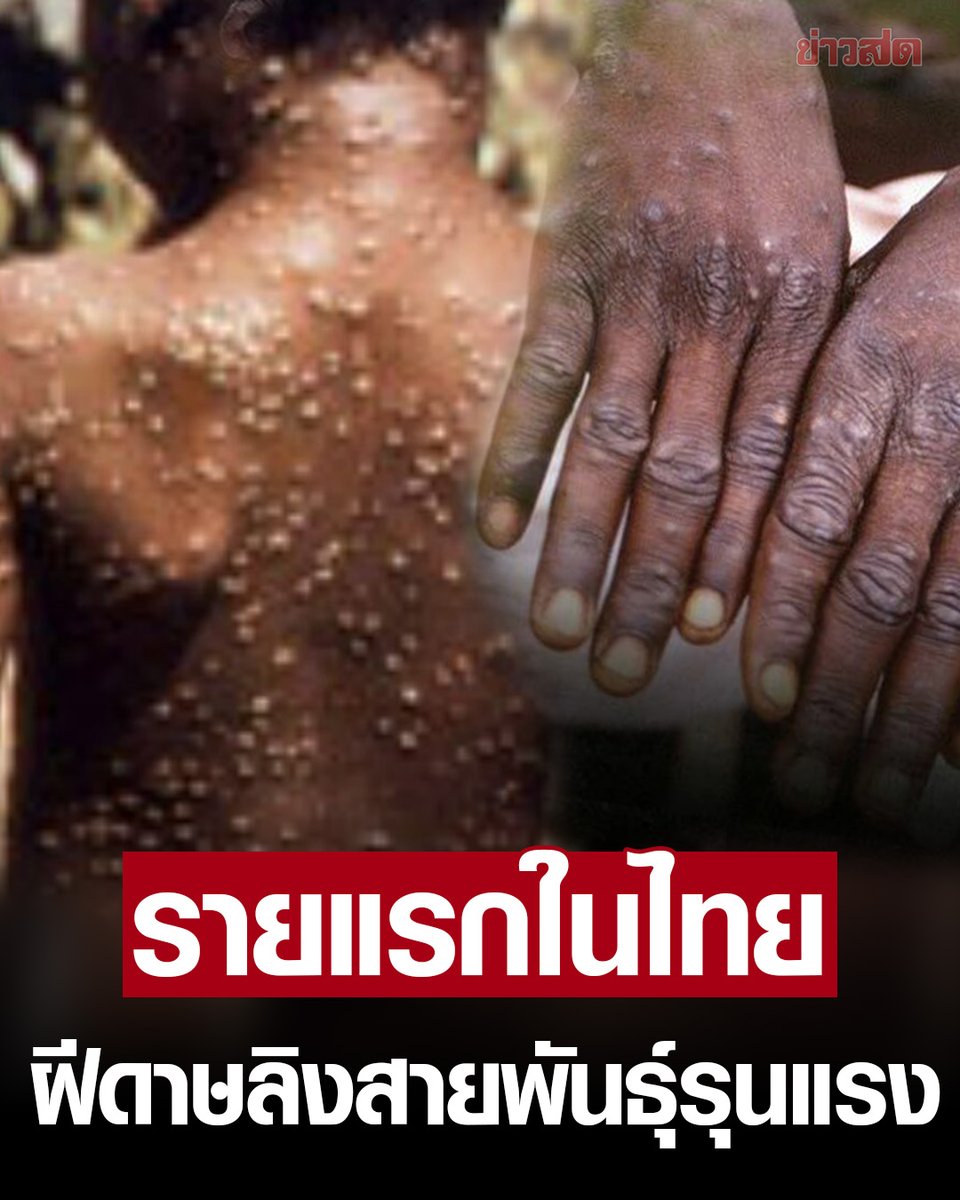 KhaosodOnline's tweet photo. ด่วน!! พบผู้ป่วย #ฝีดาษลิง  สายพันธุ์รุนแรง รายแรกของไทย

กรมควบคุมโรค เตรียมแถลงข่าวด่วน กรณีพบผู้ป่วยสงสัยโรคฝีดาษวานร (MPox) สายพันธุ์ Clade Ib รายแรกในประเทศไทย เดินทางมาจากประเทศคองโก

ทั้งนี้ องค์การอนามัยโลก (WHO) ได้ประกาศให้โรคฝีดาษวานร ในบางพื้นที่ของทวีปแอฟริกามีสถานะเป็น “ภาวะฉุกเฉินด้านสาธารณสุขระหว่างประเทศ” เมื่อวันที่ 15 สิงหาคม ที่ผ่านมา