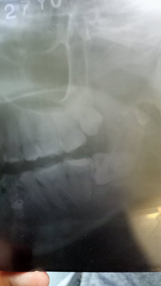 abigailmlas05's tweet photo. iyak sa impacted wisdom tooth 😭 https://t.co/7JLpQc0eWE