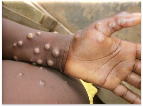 Cases of Mpox are on the rise throughout the world. We are currently deciding if we will impose another lockdown on you and re-introduce mask mandates. Stay tuned for our instructions.

Compliance will be mandatory.  

#monkeypox