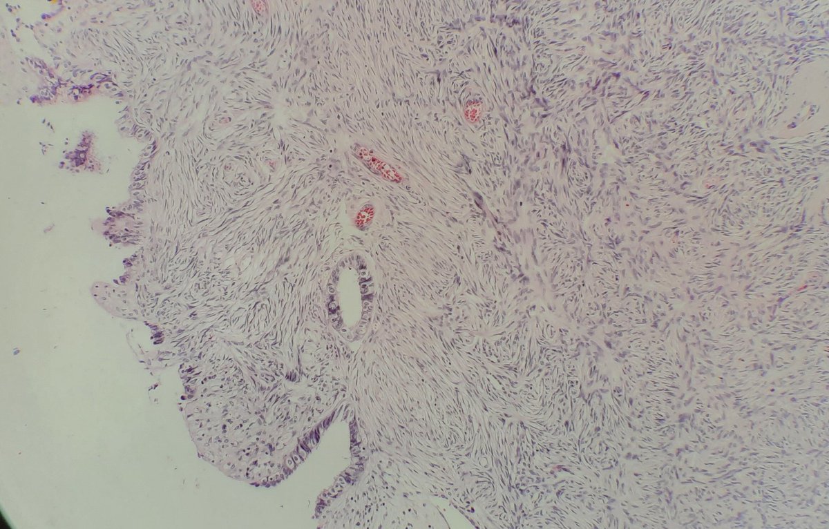 Sheelashree5's tweet photo. Cortical inclusion cyst ovary, Müllerian type. https://t.co/wbTAJ8nhVk