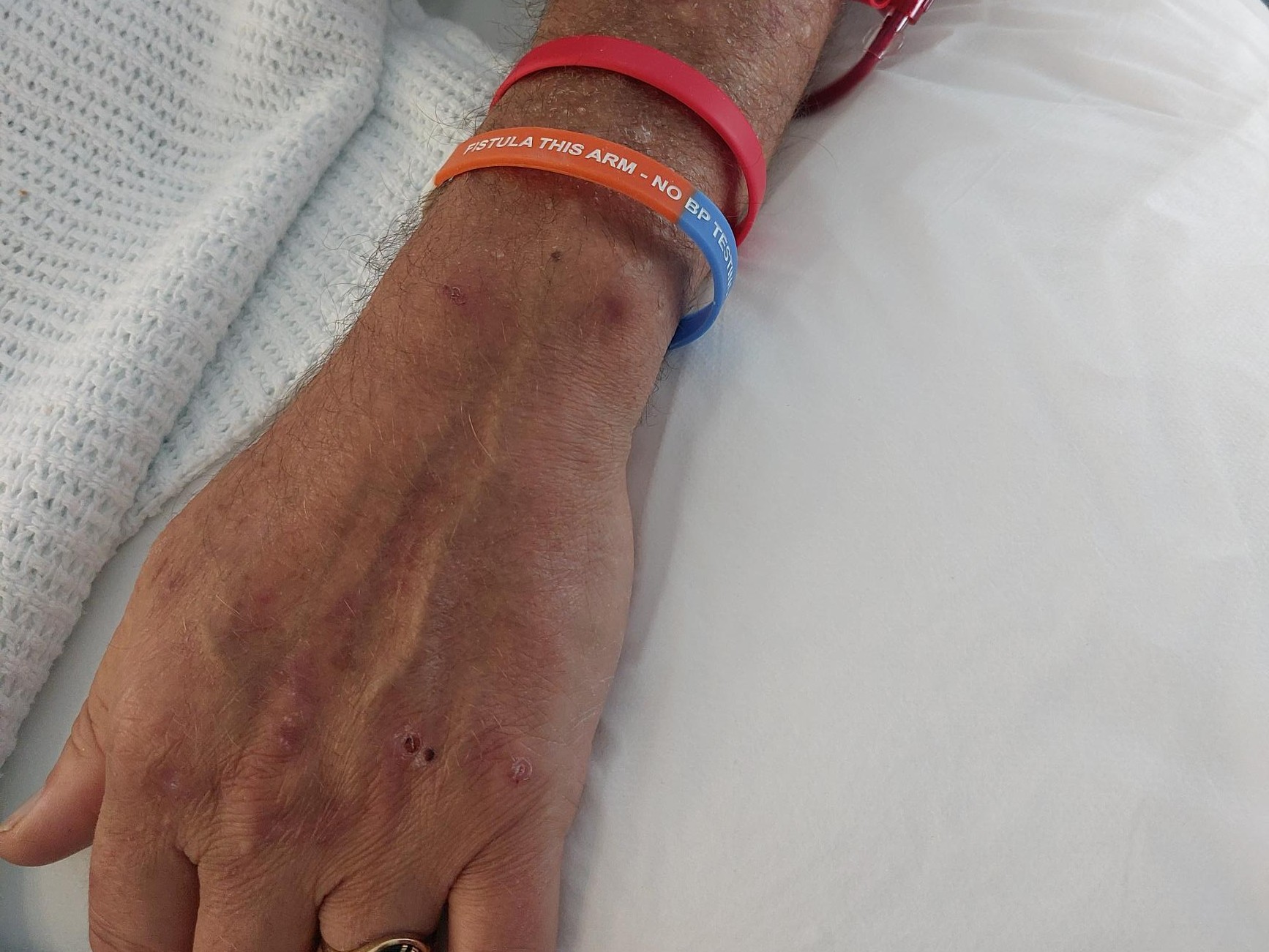 Dialysis fistula wristband deals