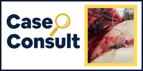 physicianswkly's tweet photo. It's time for another Case Consult!
What do you think caused this #bleeding?
Head here to provide your answer, see how did vs your peers, and learn more about the case: https://t.co/6FJb9Qsw9v
#SoMeDocs #MedTwitter #CaseConsult https://t.co/k3YUCj1CvU