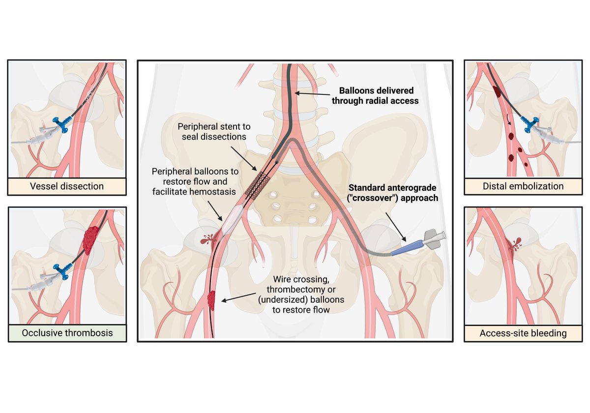 Lazzaro Paraggio (@kaysersoze84) on Twitter photo Large-bore access management is crucial in structural heart interventions.
Check out our latest review in <a href="/CircIntv/">CircInterventions</a> to explore tips to prevent vascular complications!
ahajournals.org/doi/10.1161/CI…
<a href="/BURZOTTA_F/">FRANCESCO BURZOTTA</a> <a href="/bianchinifra92/">Francesco Bianchini</a> <a href="/CristinaAuri17/">Cristina Aurigemma</a> <a href="/AndreaZito66/">Andrea Zito</a> <a href="/Emiliano_Bi2/">Emiliano Bianchini</a> <a href="/Mattialunardi/">Mattia Lunardi</a> Large-bore access management is crucial in structural heart interventions.
Check out our latest review in <a href="/CircIntv/">CircInterventions</a> to explore tips to prevent vascular complications!
ahajournals.org/doi/10.1161/CI…
<a href="/BURZOTTA_F/">FRANCESCO BURZOTTA</a> <a href="/bianchinifra92/">Francesco Bianchini</a> <a href="/CristinaAuri17/">Cristina Aurigemma</a> <a href="/AndreaZito66/">Andrea Zito</a> <a href="/Emiliano_Bi2/">Emiliano Bianchini</a> <a href="/Mattialunardi/">Mattia Lunardi</a>