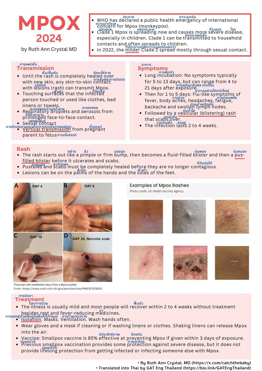 คำศัพท์และความรู้เกี่ยวกับโรค MPOX 2024
คำศัพท์หลายคำในนี้ออกข้อสอบเข้ามหาวิทยาลัยบ่อยมากหรือออกทุกปี และไม่ว่าจะเจอเรื่อง MPOX ในข้อสอบจริงหรือไม่ แต่จะได้เจอคำศัพท์หลายคำในนี้ตอนสอบจริงแน่นอน

#Dek68 #TGAT1 #ALevelEng #ฝีดาษลิง
