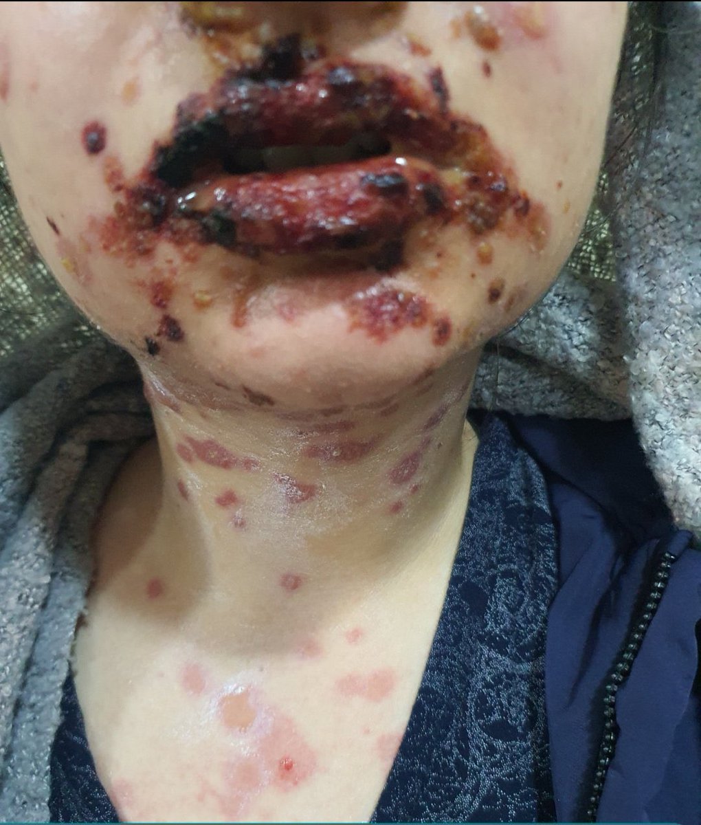 A 17-year-old female with chickenpox, treated with acyclovir tablets. 
After a few days, she presented with this lesions!?

What is the Diagnosis?
What is the Treatment?

#MEDHM #MedTwitter #MedX <a href="/IhabFathiSulima/">Dr Ihab Suliman</a> 

The source:<a href="/dermoscopy2020/">dr. s!r££n 🕊</a>