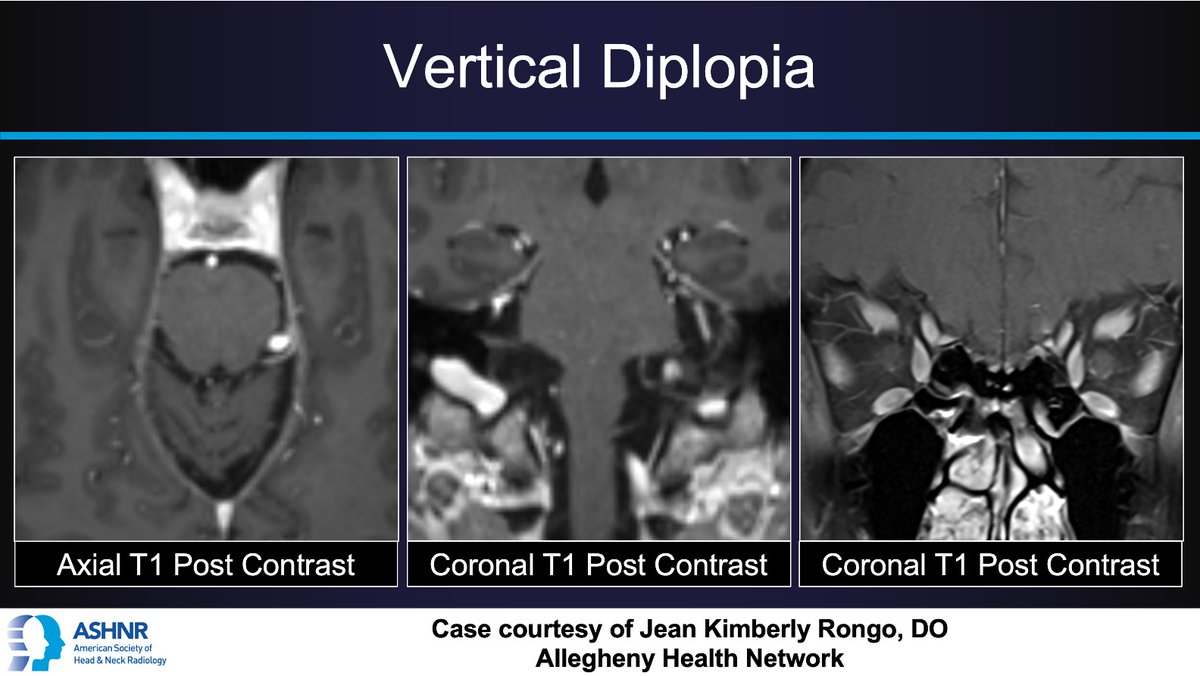 ASHNR (@ashnrsociety) on Twitter photo #ASHNRCOTW #266: Diplopia. Thx <a href="/KimberlyRongo/">Kimberly Rongo</a> 4 case! #ASHNR24
Answer w/ appropriate GIF only -- stay professional & don't spoil it!
<a href="/callyrobs/">Caroline Robson, MBChB</a> <a href="/DShatzkes/">Deborah Shatzkes</a> <a href="/CDP_Rad/">C Douglas Phillips 🇺🇸</a> <a href="/rhwiggins/">Richard Wiggins</a> <a href="/nakoontz/">Nicholas Koontz</a> <a href="/KRileyMD/">Kalen Riley</a> <a href="/CMGlastonbury/">Christine M Glastonbury, MD</a> <a href="/cmtomblinson/">Courtney Tomblinson, MD</a> <a href="/tabby_kennedy/">Tabby A. Kennedy, MD</a>
<a href="/PhilipRChapman1/">Philip R. Chapman, MD</a> #ASHNRCOTW #266: Diplopia. Thx <a href="/KimberlyRongo/">Kimberly Rongo</a> 4 case! #ASHNR24
Answer w/ appropriate GIF only -- stay professional & don't spoil it!
<a href="/callyrobs/">Caroline Robson, MBChB</a> <a href="/DShatzkes/">Deborah Shatzkes</a> <a href="/CDP_Rad/">C Douglas Phillips 🇺🇸</a> <a href="/rhwiggins/">Richard Wiggins</a> <a href="/nakoontz/">Nicholas Koontz</a> <a href="/KRileyMD/">Kalen Riley</a> <a href="/CMGlastonbury/">Christine M Glastonbury, MD</a> <a href="/cmtomblinson/">Courtney Tomblinson, MD</a> <a href="/tabby_kennedy/">Tabby A. Kennedy, MD</a>
<a href="/PhilipRChapman1/">Philip R. Chapman, MD</a>