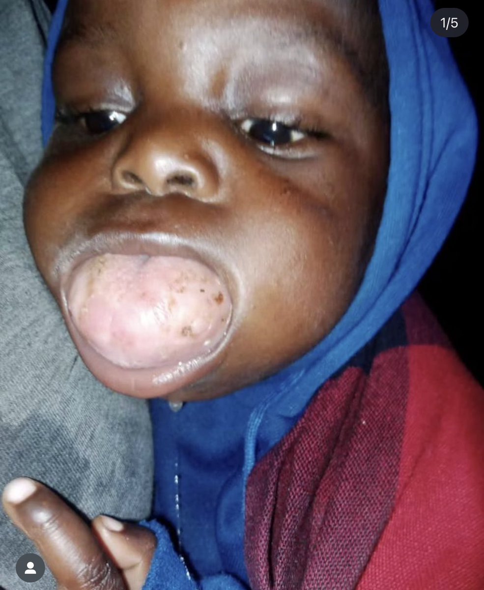 Bettynwabunikes's tweet photo. Everyone let’s join hands to pray that the treatment for this little one will heal completely in Jesus name Amen 🙏🏾 https://t.co/2kxgjjdVmS