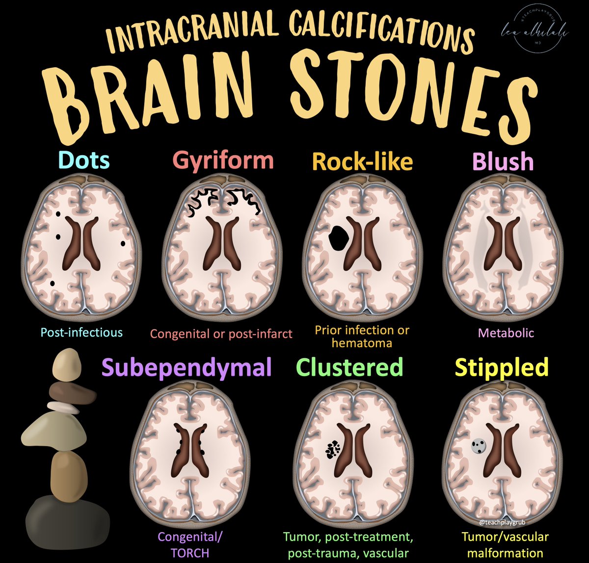 teachplaygrub's tweet photo. Stuck between a rock & a hard place when it comes to brain calcifications?!
 
Calcification pattern is key to rocking the diagnosis!
 
Here's a quick guide to the most common entities associated w/different patterns!
 
Here's how to always remember the calcification patterns:

For the three most common patterns, I remember what you do when ROCK music plays:
 
I HeaR = Infection & Hematoma give a Rock pattern
I GYRate = Infarct give a GYRiform
And finally...
I Dab = Infection gives tiny Dabs or Dots everywhere
 
For the rest:
If they are grouped: think tumor or vascular
If they are diffusion: think metabolic
If they are along the ventricle: think TORCH
 
Now hopefully you can rock & roll when it comes to the diagnoses for intracranial calcifications!