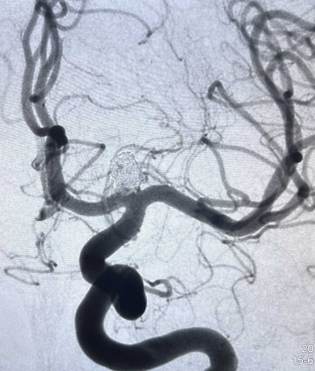 The good old coiling 😊. #aneurysm #neurointerventional #NRI 

<a href="/eloncharic/">Esteban Loncharic</a>