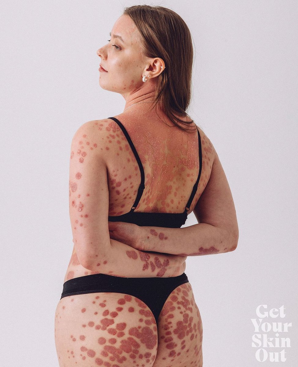 I am attending the pop-up photo exhibition at Peckham Arches this Saturday, August 24th, from 2-8 PM. Join me in celebrating the beauty of real skin! <a href="/GetYourSkinOut/">GetYourSkinOut</a> instagram.com/p/C-77NAfIO8O/…