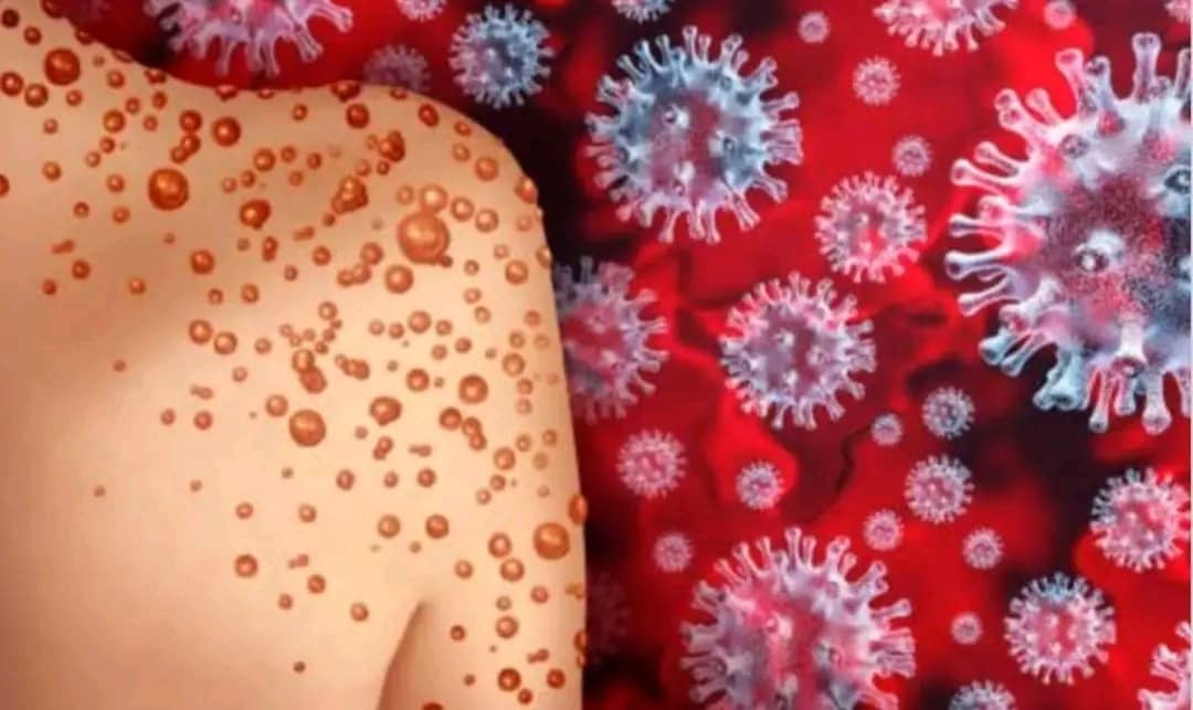 Mpox is a rare viral disease caused by infection with the Mpox virus.

Click on this link to get the full story👇🏻

facebook.com/groups/3186086…