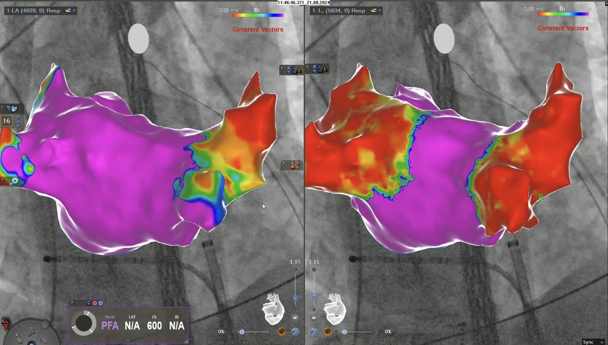 Leon Iden (@idenleon) on Twitter photo Amazing first experience with @BiosenseWebster
⚡️⚡️⚡️Varipulse PFA⚡️⚡️⚡️
➡️ Impressive stability
➡️ Instant PVI
➡️ Full mapping power
Proud to be part of this journey as 3️⃣rd clinic in 🇩🇪.
Thank you for great team effort & support.
<a href="/MartinBorlich/">Martin Borlich</a> <a href="/HolgerNef/">Holger Nef</a> @seriedel Amazing first experience with @BiosenseWebster
⚡️⚡️⚡️Varipulse PFA⚡️⚡️⚡️
➡️ Impressive stability
➡️ Instant PVI
➡️ Full mapping power
Proud to be part of this journey as 3️⃣rd clinic in 🇩🇪.
Thank you for great team effort & support.
<a href="/MartinBorlich/">Martin Borlich</a> <a href="/HolgerNef/">Holger Nef</a> @seriedel