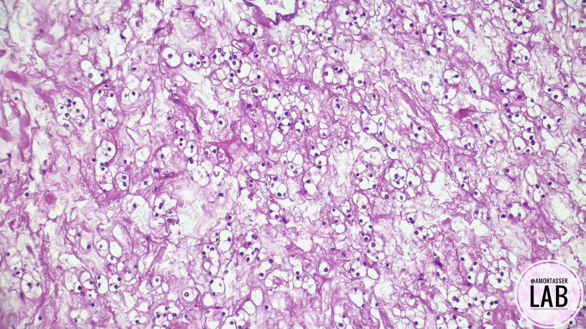 AMontasserMD's tweet photo. I can’t get enough of these 🤩

Partial nephrectomy 

#GUpath #Pathology #PathX #Grossognosis #PathClassic https://t.co/sdb9tXI2in
