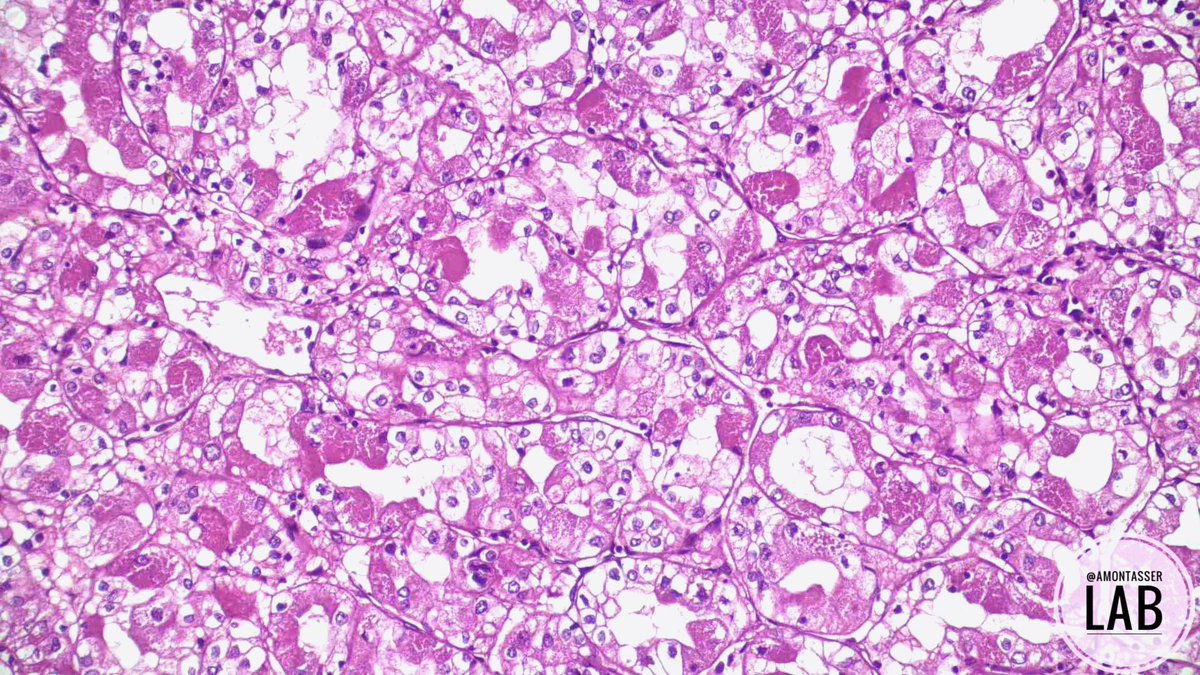 AMontasserMD's tweet photo. I can’t get enough of these 🤩

Partial nephrectomy 

#GUpath #Pathology #PathX #Grossognosis #PathClassic https://t.co/sdb9tXI2in