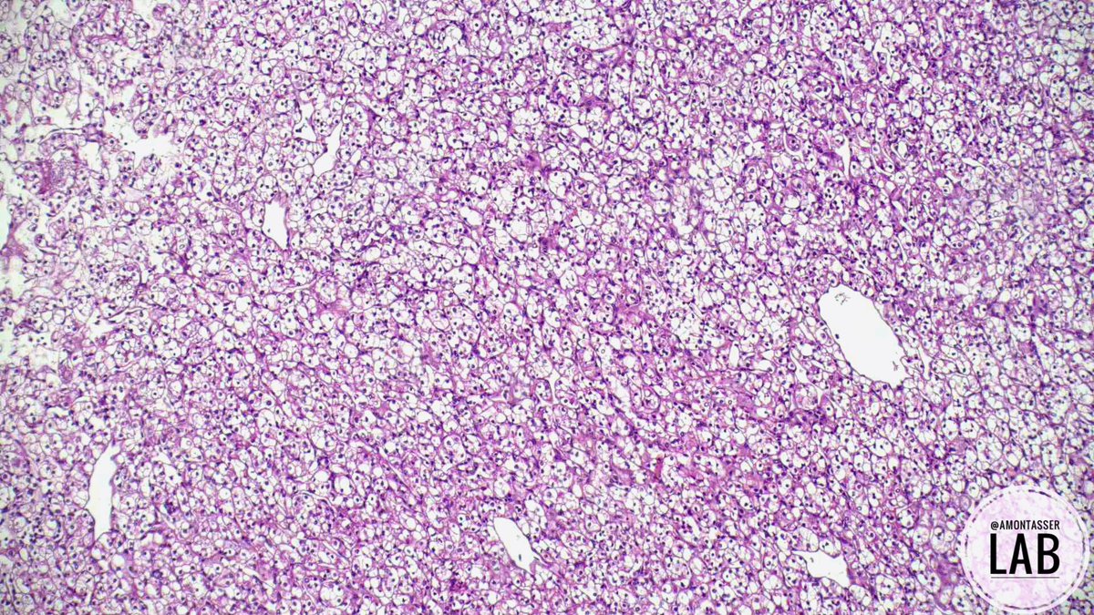 AMontasserMD's tweet photo. I can’t get enough of these 🤩

Partial nephrectomy 

#GUpath #Pathology #PathX #Grossognosis #PathClassic https://t.co/sdb9tXI2in