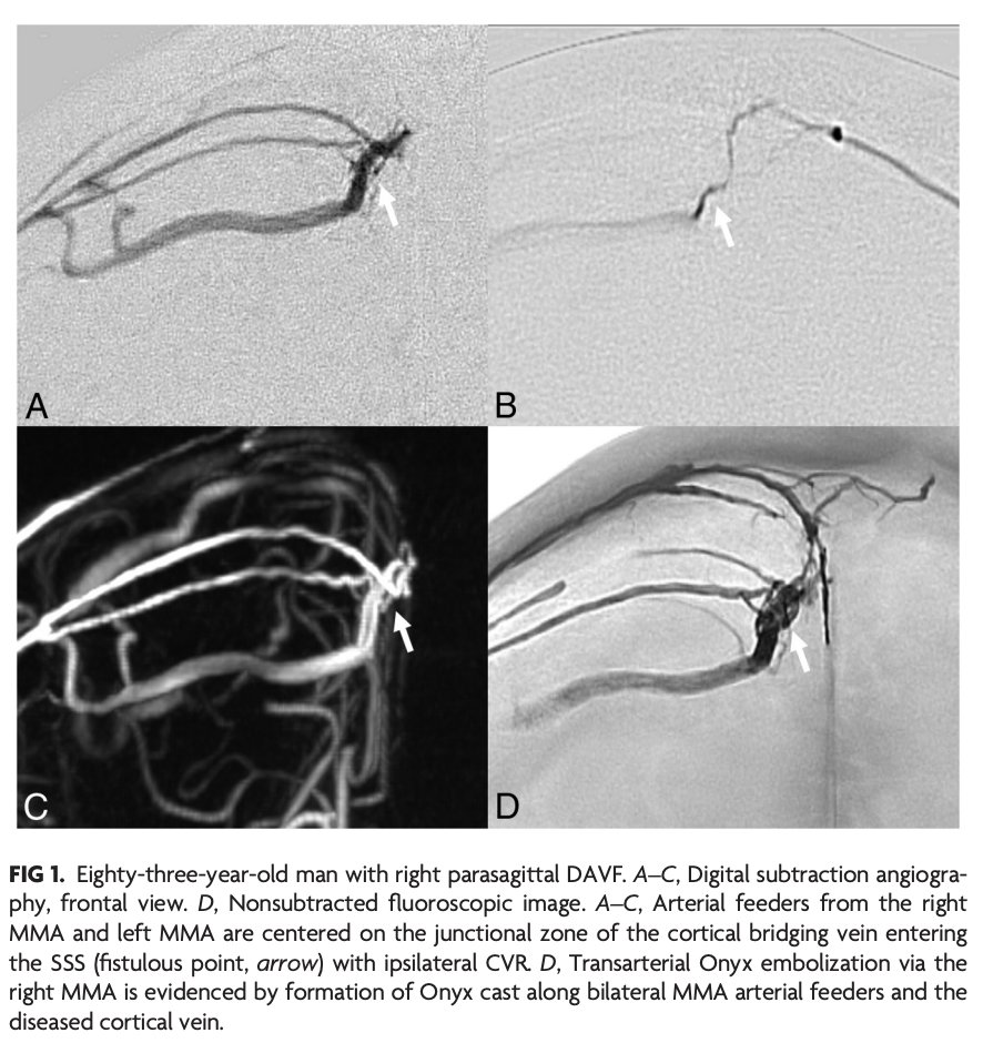 TheAJNR's tweet photo. "Parasagittal and Superior Sagittal Sinus Dural Arteriovenous Fistulas: Clinical Presentations, Imaging Characteristics, and Treatment Strategies"
https://t.co/dZYHHnA0gt
#FellowsJournalClub #dAVF https://t.co/pqbFnmctwz