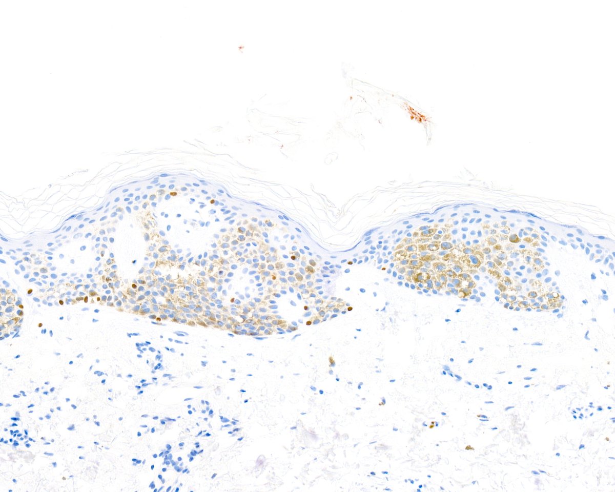 This is more of a question than an answer. Balloon cell change in an SK? Weird stuff. Just to pre-answer a potential loose end, the included SOX10 immunostain confirms that the fluffy stuff is non-melanocytic.